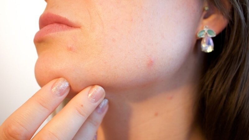 Jakie kosmetyki stosować do pielęgnacji skóry z trądzikiem?